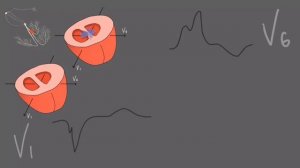 Блокада левой ножки пучка Гиса.