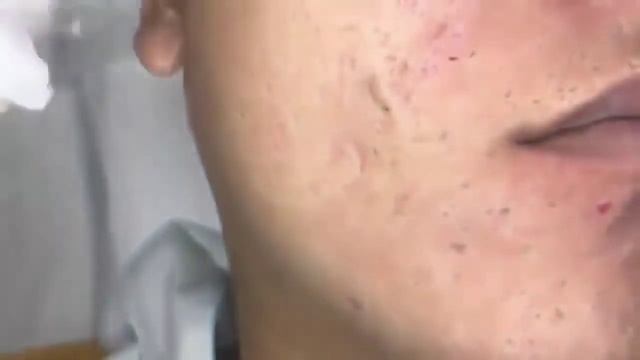 ВЫЖИМАЕМ ЧЕРНЫЙ ПРЫЩ смотреть онлайн