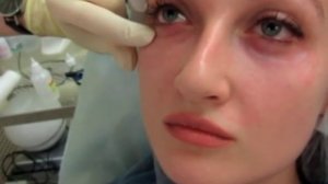 коррекция носослезной борозды филлерами