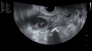 Киста жёлтого тела яичника на УЗИ, что это