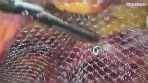 Лапароскопическая коррекция двухсторонней паховой грыжи сетчатым имплантом