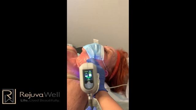 BTL Exilis Ultra смотреть онлайн