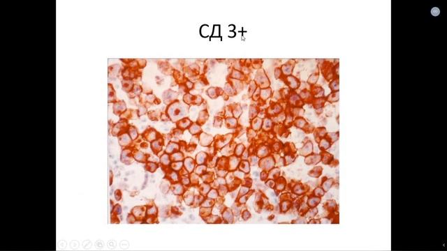 Патанатомия. Лекция 13. Гемобластозы. ДМН, проф Кирьянов Н.А. 20.04.2020