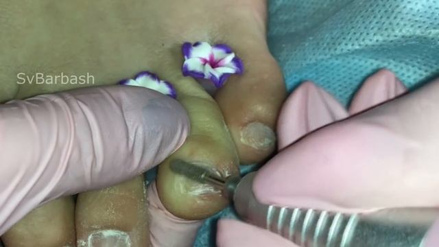 ►УЖАСНЫЙ Педикюр. ВРОСШИЙ НОГОТЬ.ПРЕОБРАЖЕНИЕ ? НЕ ДЛЯ СЛАБОНЕРВНЫХ.? Педикюр От и До. Педикюр дома смотреть онлайн