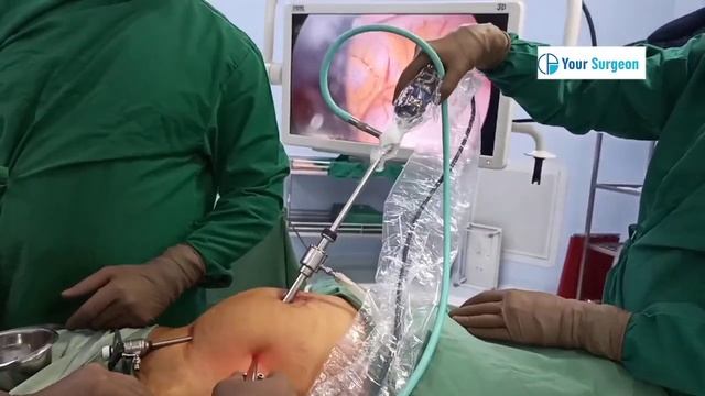क्या , क्यों, कैसे ? दूरबीन ऑपरेशन - Laparoscopic Surgery смотреть онлайн