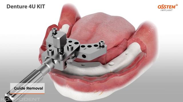 Osstem Implant Denture 4U KIT