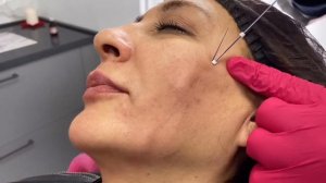 Установка нитей PDO c когами