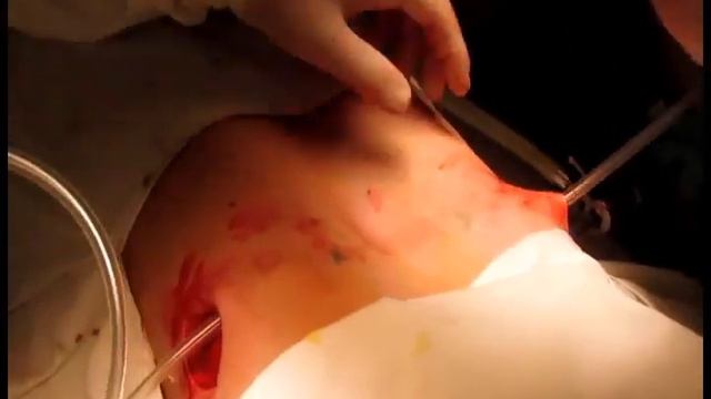 Воронкообразная грудная клетка и её лечение смотреть онлайн