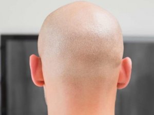 Универсальная алопеция.