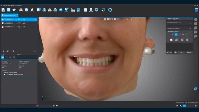 ObiScanner: Superimposition with Dental Wings смотреть онлайн