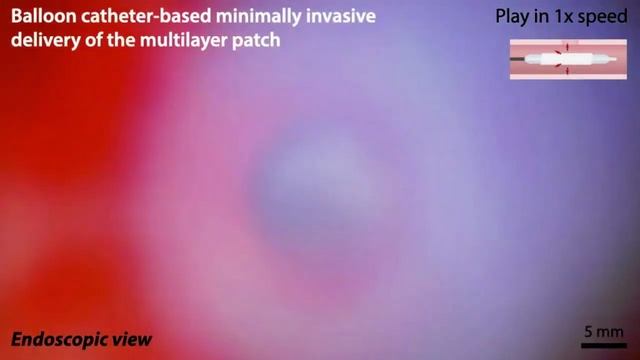 An origami-inspired medical patch for sealing internal injuries without open surgery смотреть онлайн