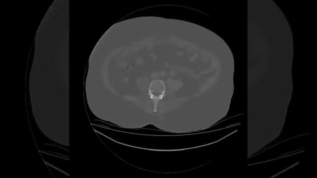 липосаркома бедра смотреть онлайн