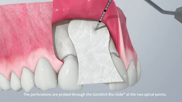 Применение Bio Oss collagen техника L