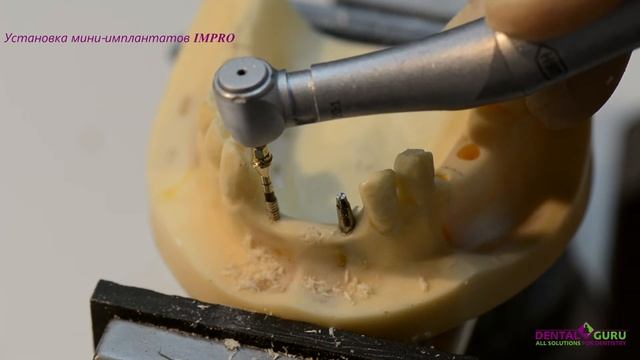 Установка мини имплантатов IMPRO