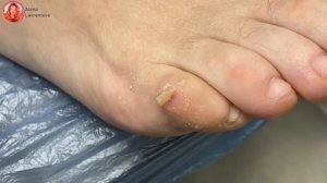 Стержневая мозоль / Мозоль на мизинце / Как убрать мозоль / Педикюр