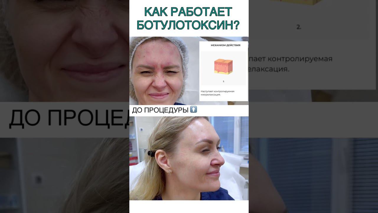 Как работает #ботокс #диспорт #миотокс смотреть онлайн