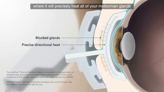 LipiFlow | Clearvue Vision Center смотреть онлайн