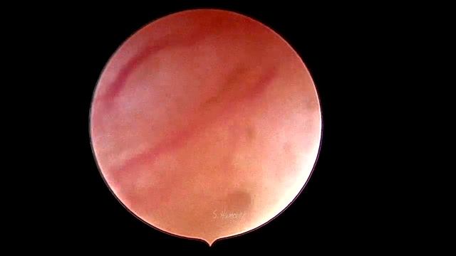 office procedure for external and internal os stenosis смотреть онлайн