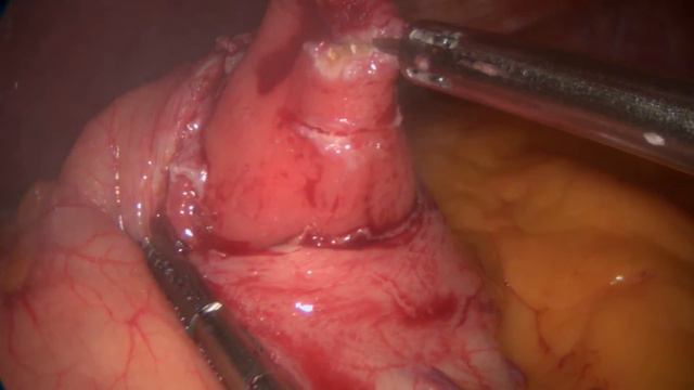 Laparoscopic polypectomy to stomach смотреть онлайн