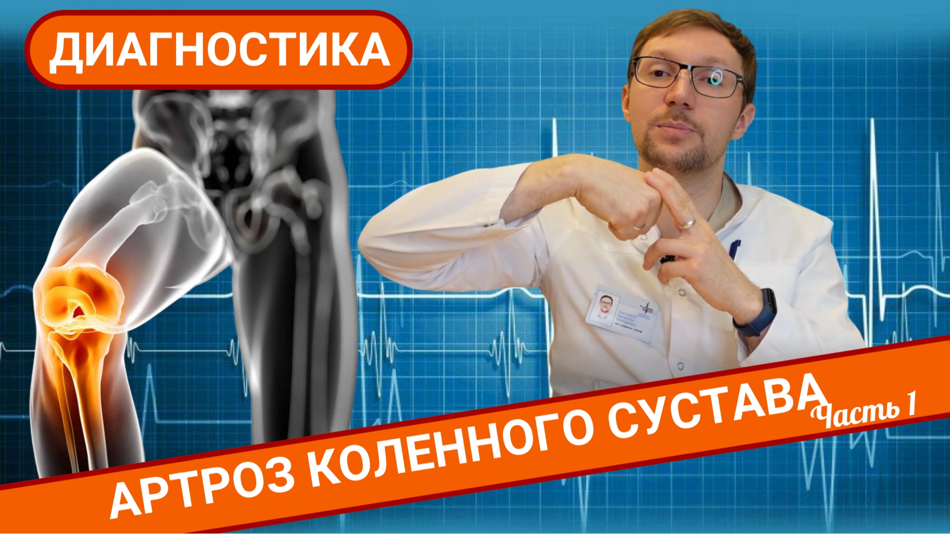 АРТРОЗ КОЛЕННОГО СУСТАВА. ДИАГНОСТИКА. (Часть 1) смотреть онлайн