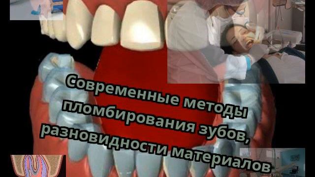 Современные методы пломбирования зубов, разновидности материалов смотреть онлайн