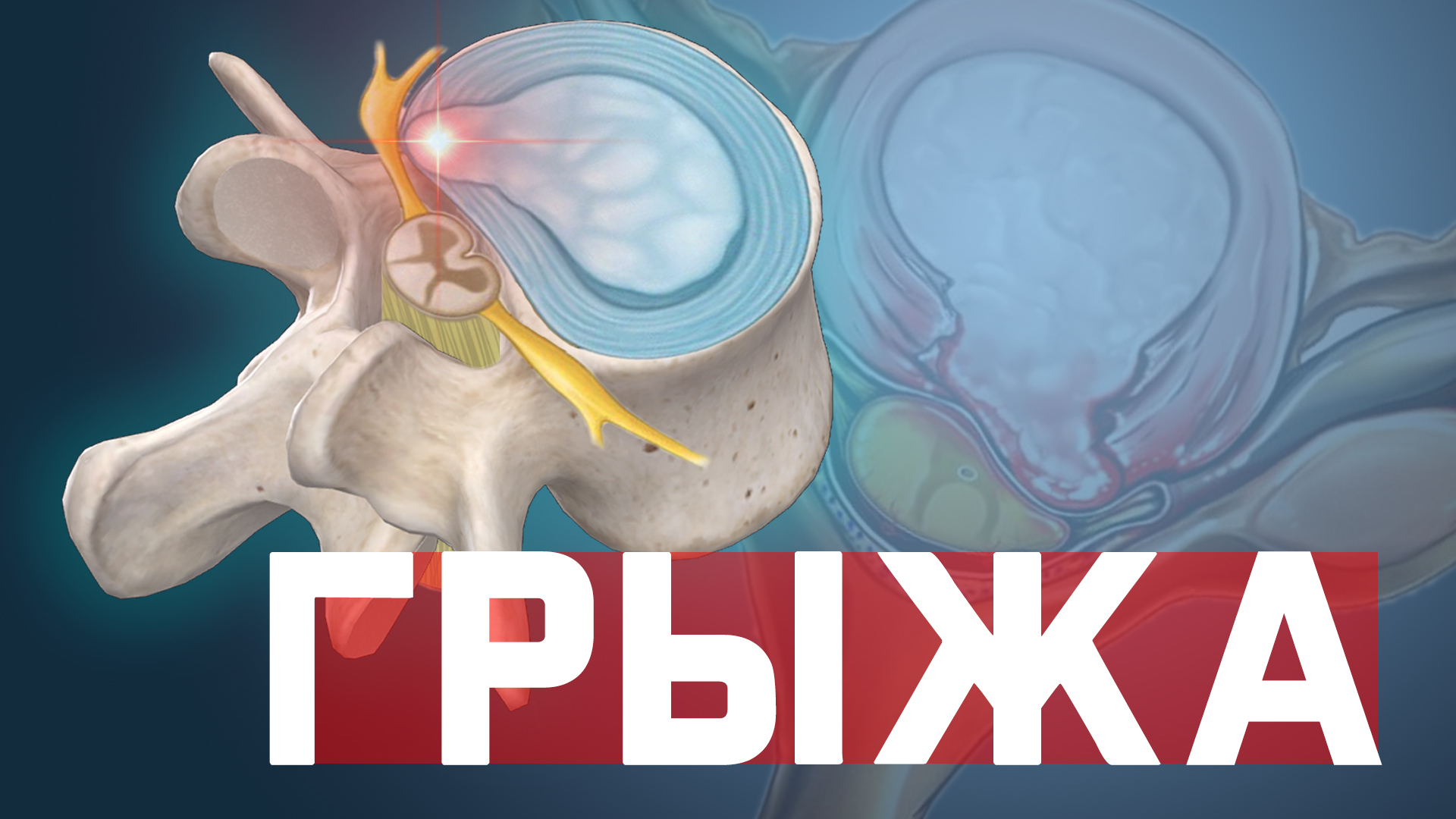 Позвоночная грыжа. Грыжа диска. Что делать? Как лечить? смотреть онлайн