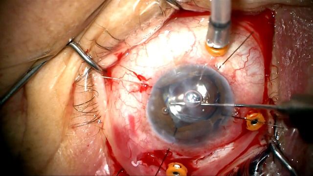 Pars plana vitrectomy+ tube shunt/IOL exchange/iris repair by Steven G. Safran MD смотреть онлайн