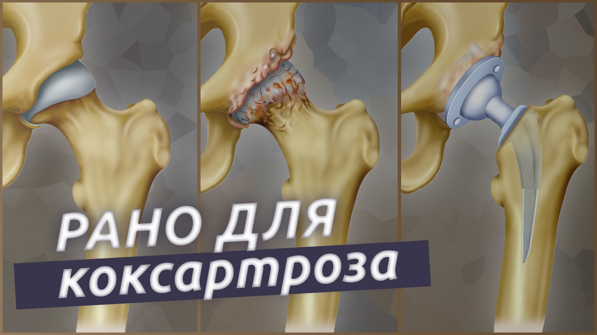 Боль в бедре это коксартроз? Как не допустить замену сустава? смотреть онлайн