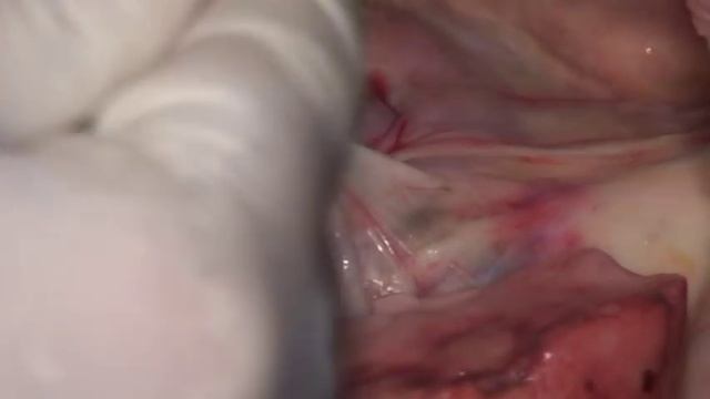 Павел Пульняшенко: лобэктомия, труп модель смотреть онлайн