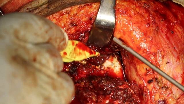 Ligation of Maxillary Artery смотреть онлайн