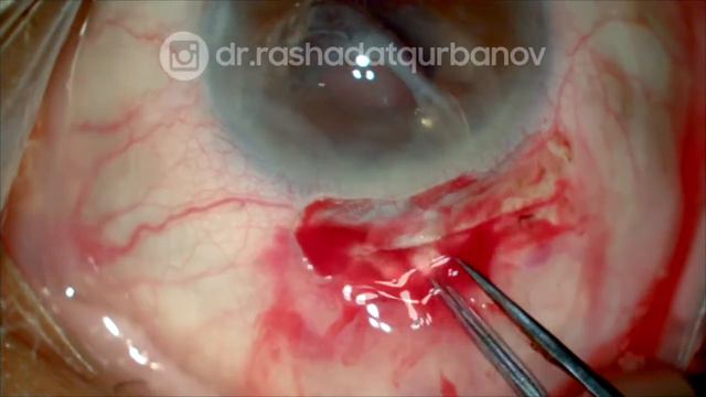 Subluxated IOL to Iris claw IOL (Замена сублюксированной заднекамерной ИОЛ на ирис-клипс ИОЛ) смотреть онлайн