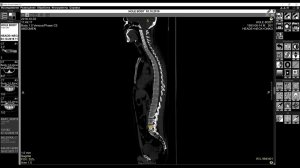 Обучающее видео «Ручная разметка позвоночника»