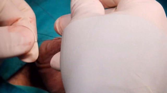 Vasectomy (Male Sterilization)