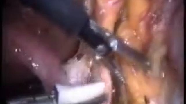 Laparoskopik Pelvik Lenkfadenektomi 1 смотреть онлайн