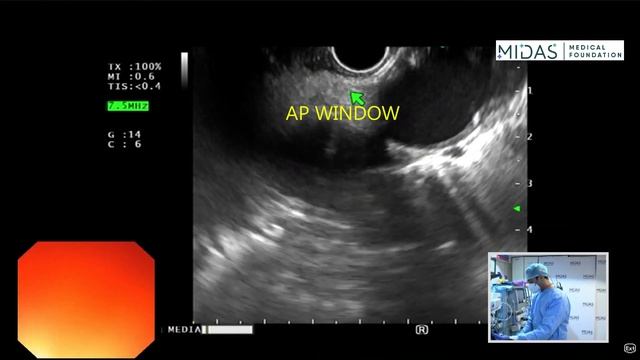 EUS examination of mediastinum (Aorto-Pulmonary window) смотреть онлайн