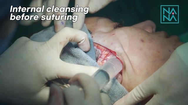[LIVE] MINI FACELIFT | QUICK, MACRO AND NON-INVASIVE MACS LIFTING | BEFORE AND AFTER RESULTS смотреть онлайн