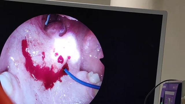 RF mehkega neba + uvuloplastika смотреть онлайн