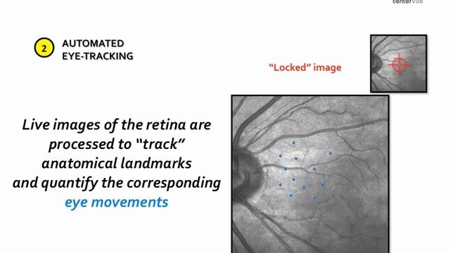 MAIA Macular Integrity Assessment смотреть онлайн