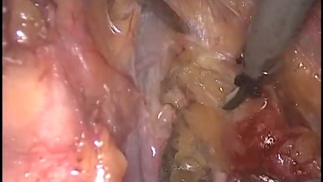 Pelvic lymph node dissection смотреть онлайн