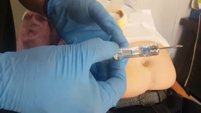 Zoladex S/C implant смотреть онлайн