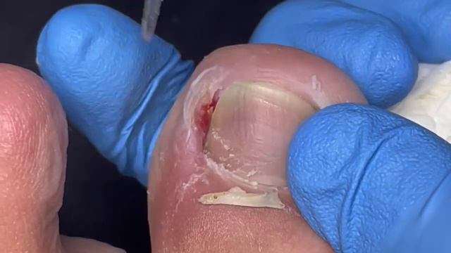The nail grew inward crazily and became very swollen【Lao Daoke】 смотреть онлайн