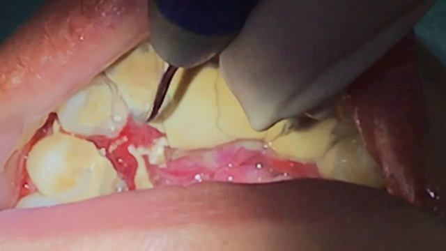 Houston Cosmetic Dentist...Worst Tartar I have seen! Watch how we remove it... смотреть онлайн
