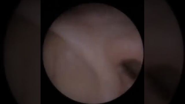 Серная пробка - удаление, чистка ушей 2021 смотреть онлайн