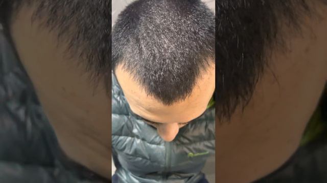 Использование генеролона 5% от облысения спустя 9 дней