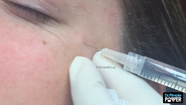 Extracting a Milia under the eye смотреть онлайн