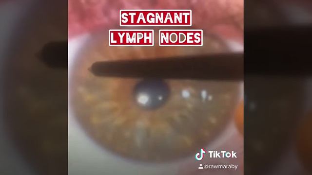 Stagnant and swollen lymph nodes seem in the eyes -iridology смотреть онлайн