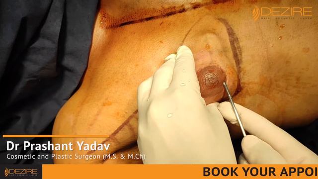 Say Goodbye to Gynecomastia !! VASER Liposuction & Gland Removal смотреть онлайн