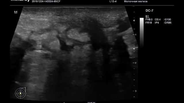 Протоки молочной железы под Новый год! смотреть онлайн