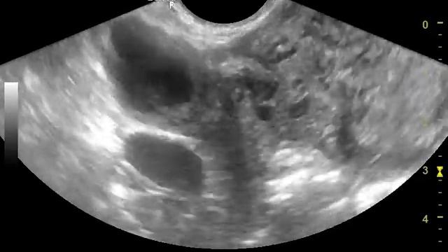 УЗИ киста желтого тела и эндометриоидная киста в одном яичнике смотреть онлайн