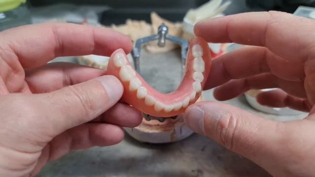 №33 - Съёмный протез на балке + 4 импланта